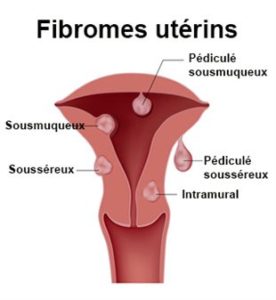 Types des fibromes utérins