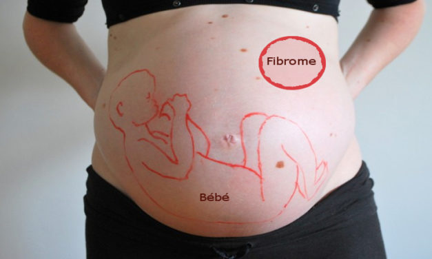 uterine fibroma and pregnancy |  My gynecologist and I