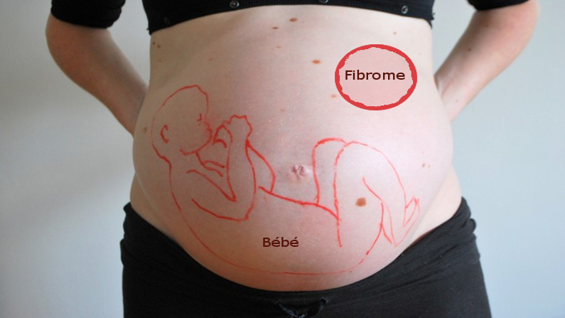 Fibrome utérin et grossesse – risques et prise en charge